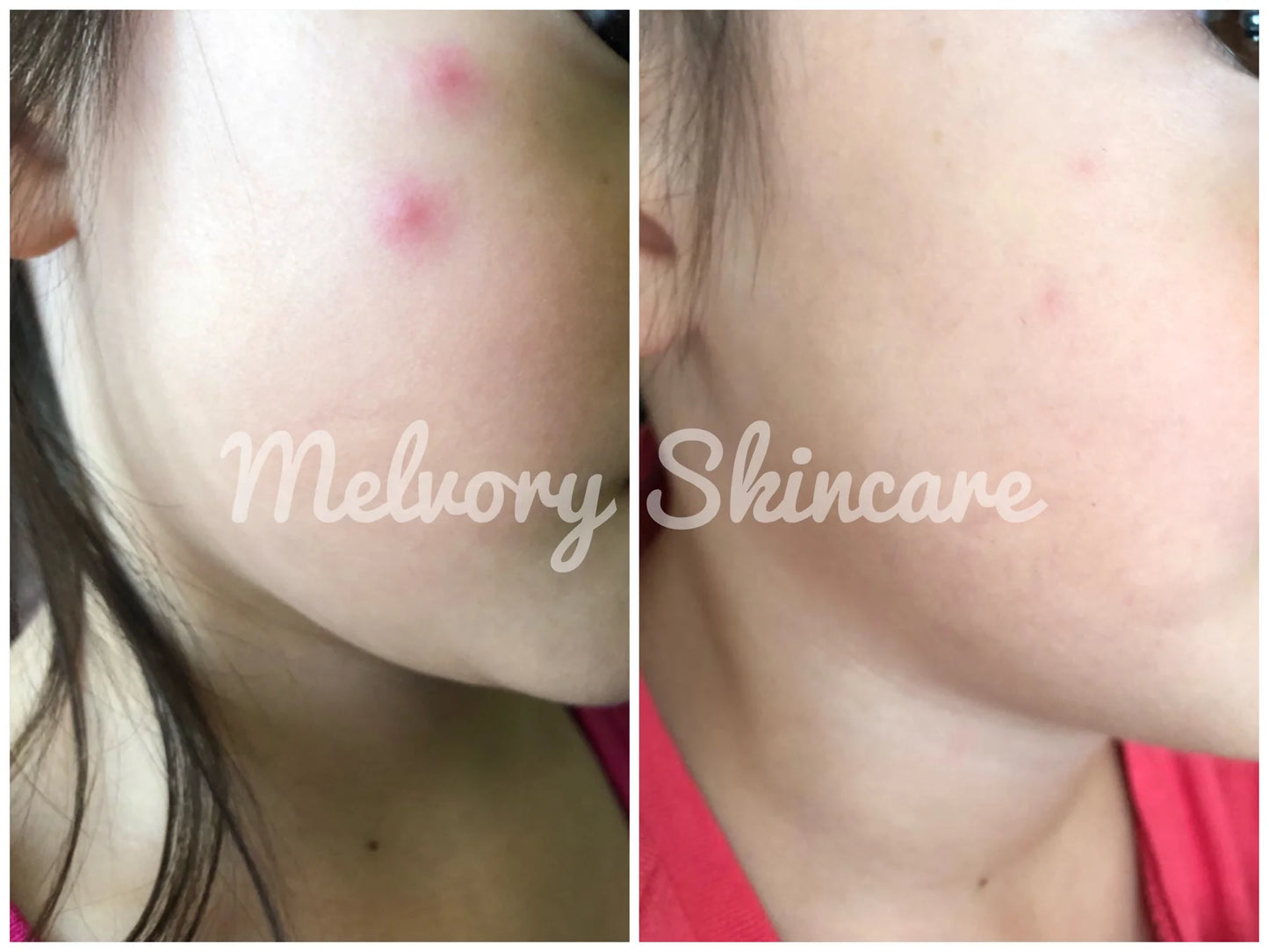 MOZZIE BALM